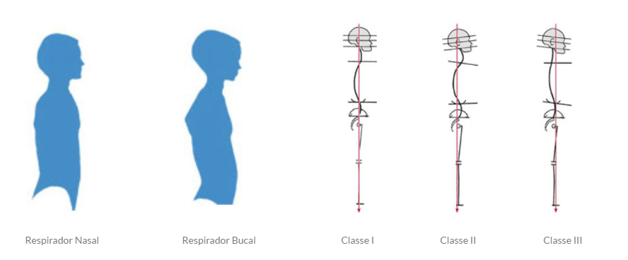 Respirador Nasal Respirador Bucal Classe I Classe II Classe III